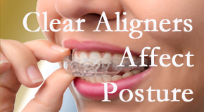 Clear aligners influence posture which Vancouver chiropractic helps.