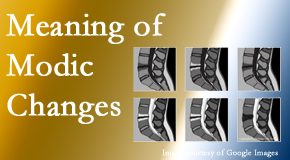 Vancouver Disc Centers sees many back pain and neck pain patients who bring their MRIs with them to the office. Modic changes are often noted. 