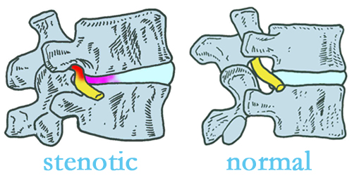 Vancouver stenotic and normal spinal discs
