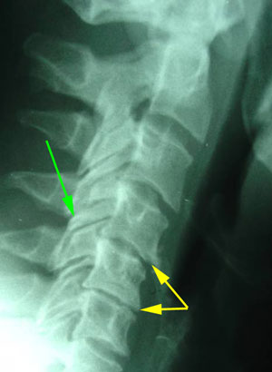 disc degeneration treated at Vancouver Disc Centers