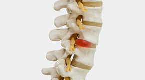 Vancouver chiropractic conservative care helps even giant disc herniations go away