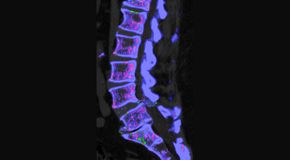 Vancouver Disc Centers is aware that inflammatory spinal gout is a differential diagnosis to consider for patients who present with back pain and other spine related symptoms.