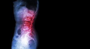 Vancouver Chiropractic Care of Spondylolisthesis 