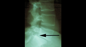 Vancouver spondylolisthesis 