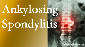 Ankylosing spondylitis is gently cared for by your Vancouver chiropractor.