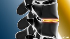 Vancouver degenerative spinal changes 