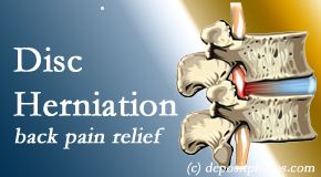 Vancouver Disc Centers uses non-surgical treatment for relief of disc herniation related back pain. 