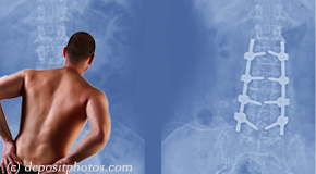 Vancouver chiropractic relief for back pain after back surgery