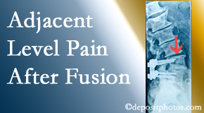 Vancouver Disc Centers offers relieving care non-surgically to back pain patients experiencing adjacent level pain after spinal fusion surgery.