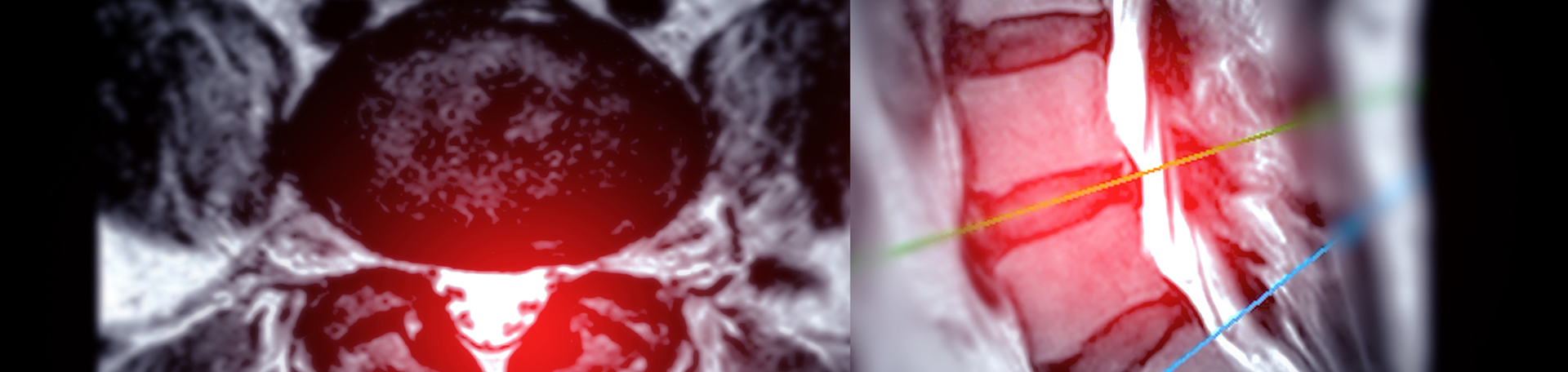 Vancouver back pain imaging and exercise