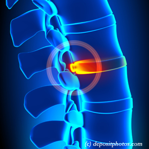 picture of lumbar Vancouver disc herniation