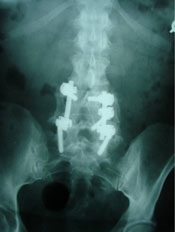 post surgical bolt fusion lumbar spine