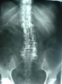 scoliosis with spinal stenosis